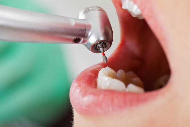 Best Emergency Tooth Extraction in Henderson, TX
